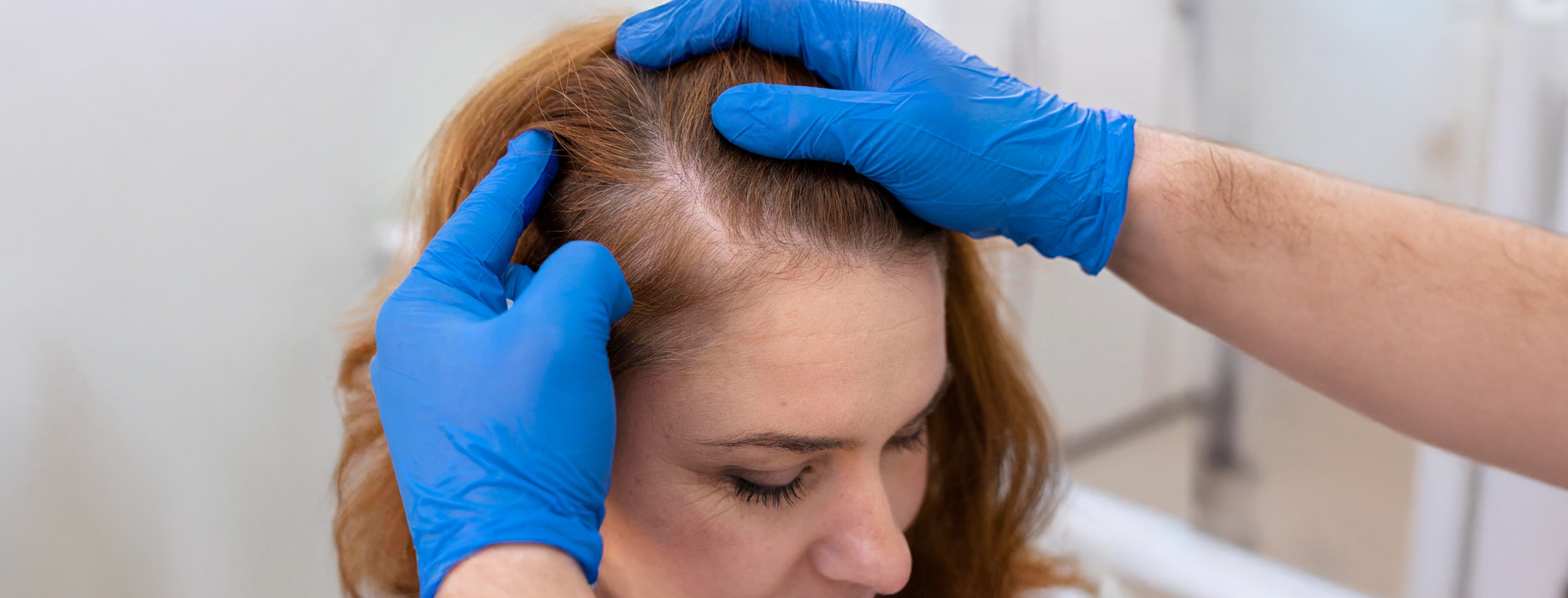 calvizie Bimatoprost nel trattamento dell’alopecia