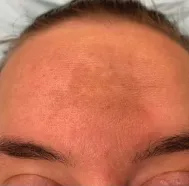 Melasma, iperpigmentazione della fronte. Tratto da Doolan B.J. & Gupta M. 2021. Aust J Gen Pract; 50(12): 880-85.