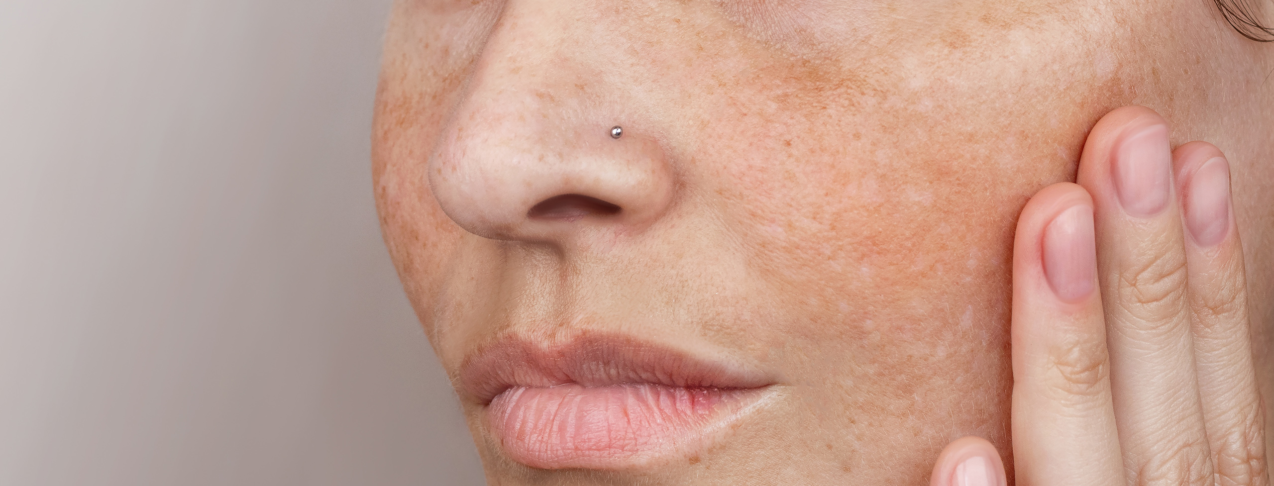 Acido tranexamico per macchie cutanee e melasma